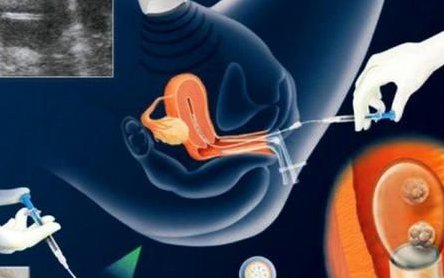 南宁生殖医院做试管大概要多少钱？费用究竟差在哪？